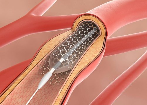   Angioplasty